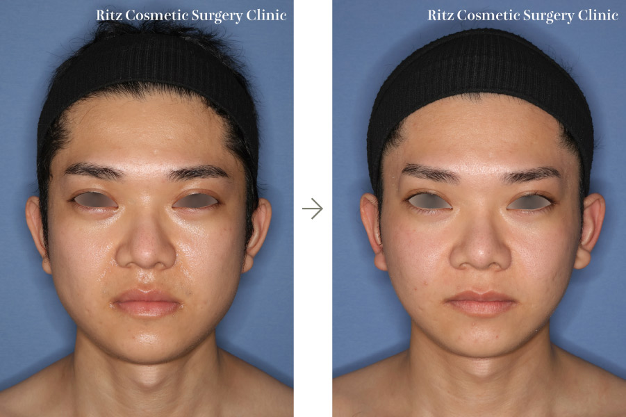 症例写真:下顎形成術(下顎角切除+外板切除+咬筋焼灼)+下顎枝垂直骨切り術(IVRO)