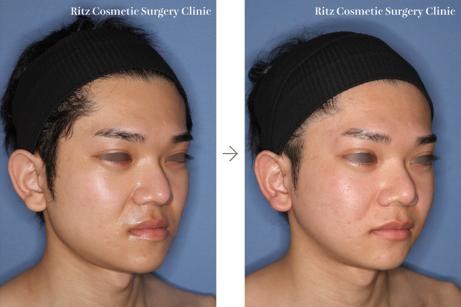 症例写真:下顎形成術(下顎角切除+外板切除+咬筋焼灼)+下顎枝垂直骨切り術(IVRO)