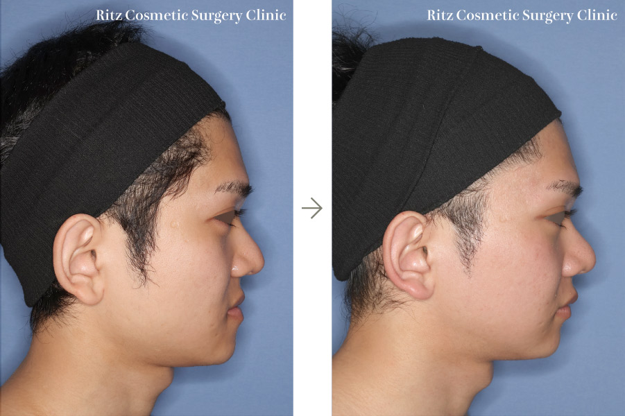 症例写真:下顎形成術(下顎角切除+外板切除+咬筋焼灼)+下顎枝垂直骨切り術(IVRO)