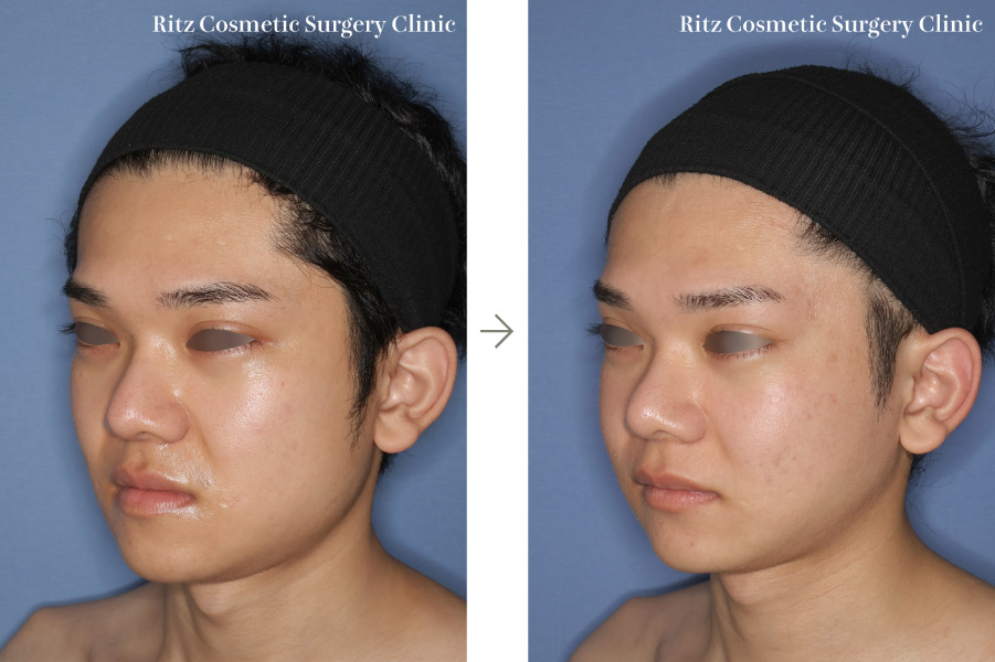 症例写真:下顎形成術(下顎角切除+外板切除+咬筋焼灼)+下顎枝垂直骨切り術(IVRO)