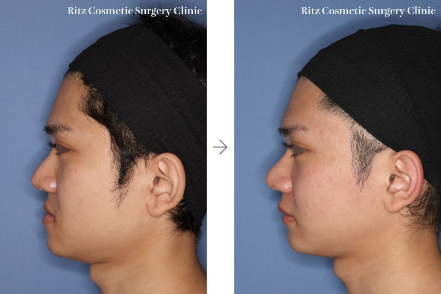 症例写真:下顎形成術(下顎角切除+外板切除+咬筋焼灼)+下顎枝垂直骨切り術(IVRO)