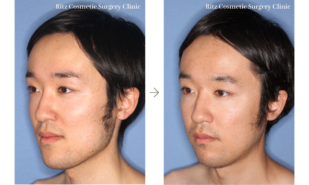 症例写真：下顎枝矢状分割術（SSRO）＋下顎形成術（外板切除）(左斜め)