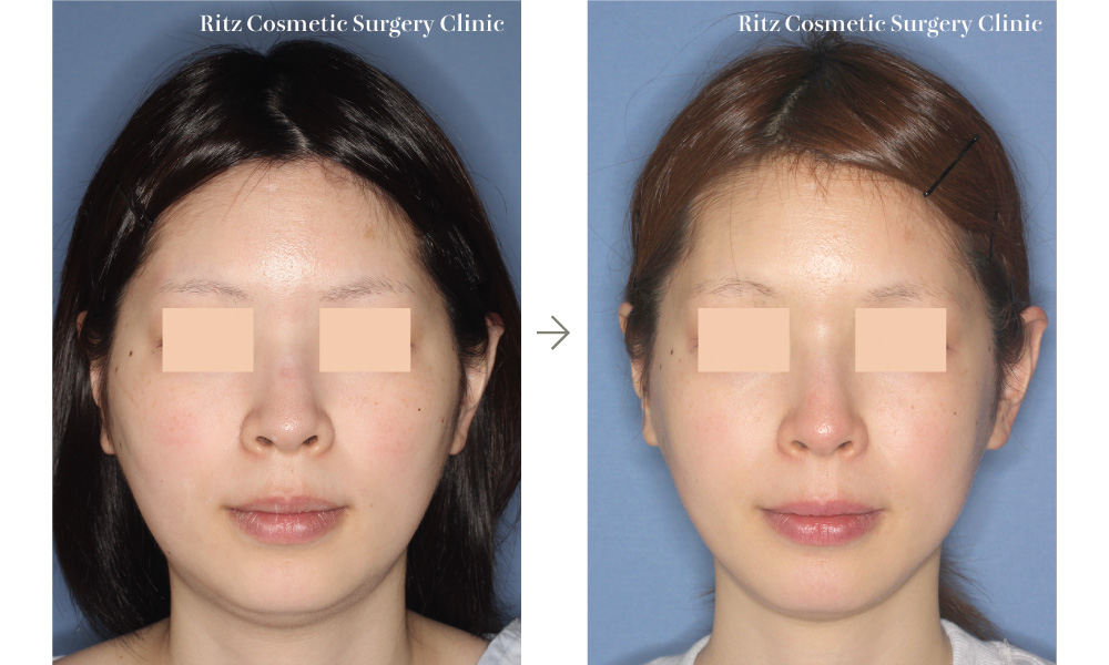 頬骨縮小術+下顎形成術の症例写真