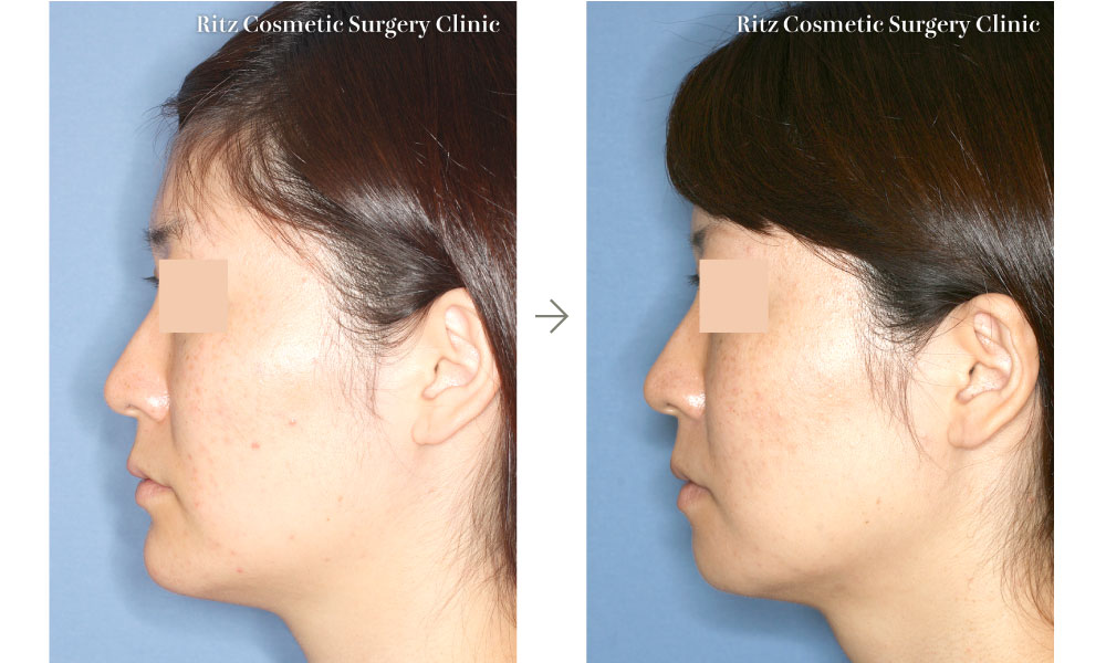 症例写真：オトガイ前額断骨切り術（後退術）（右側面）