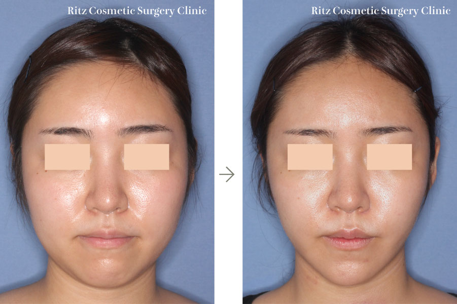 症例写真（腫れの変化）：オトガイVライン形成術＋頬骨縮小術(正面)