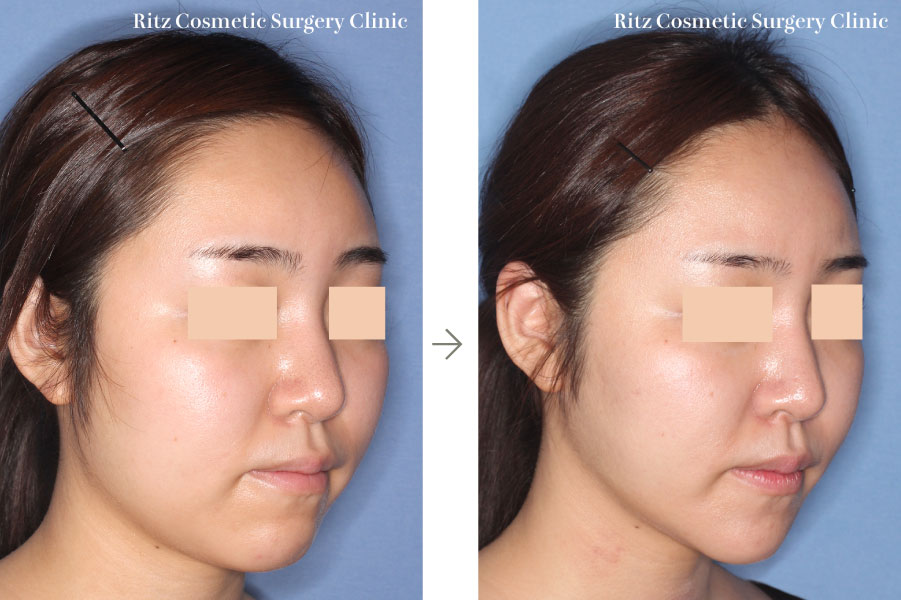 症例写真：オトガイVライン形成術＋頬骨縮小術(右斜め)