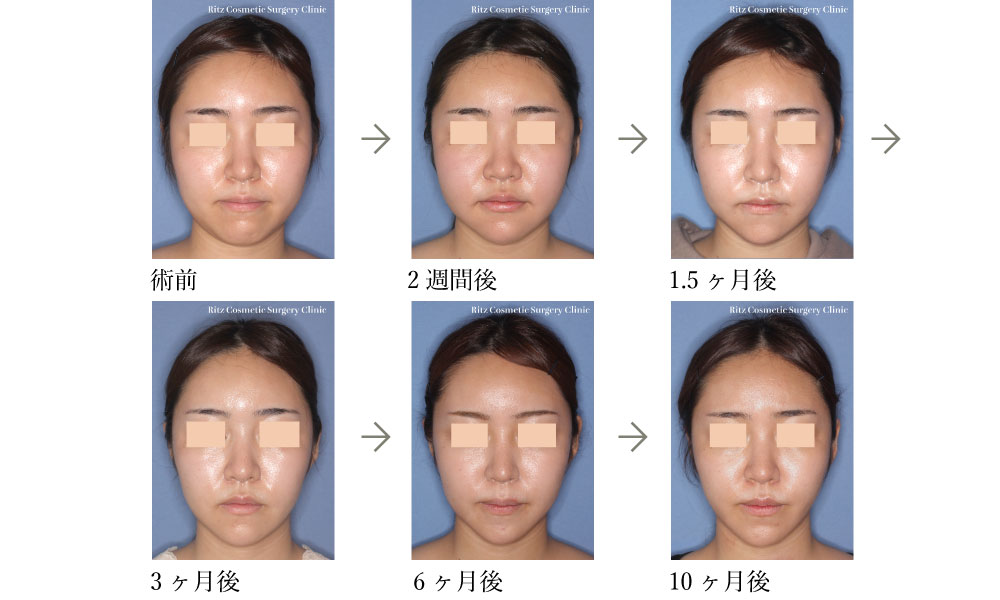 症例写真：オトガイVライン形成術＋頬骨縮小術