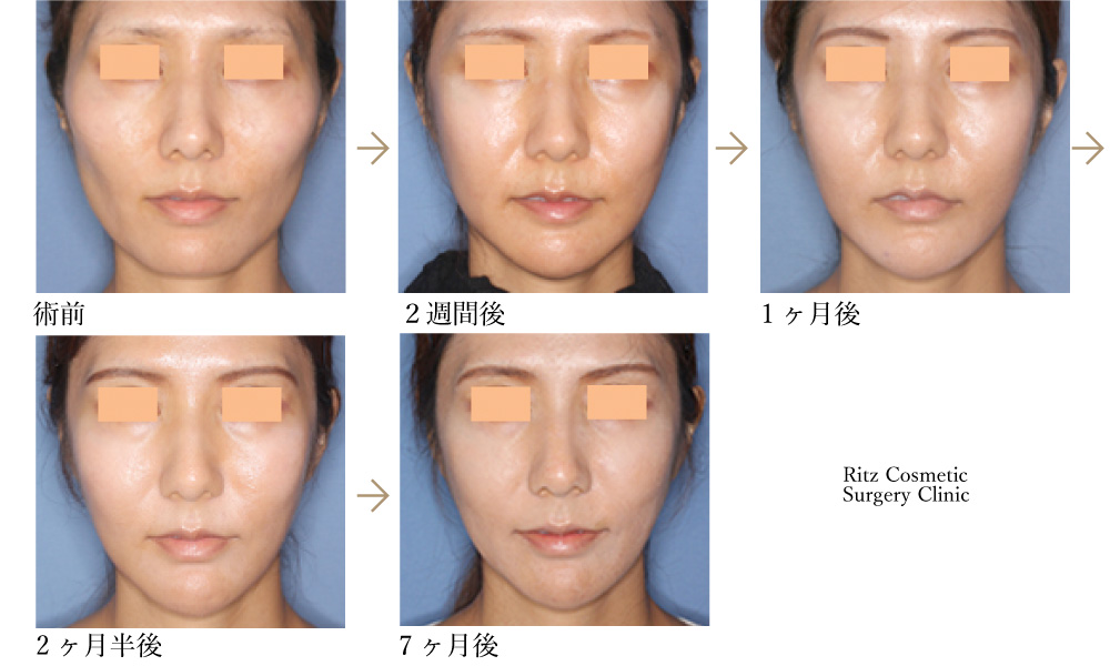 症例写真（腫れの変化）：頬骨縮小術＋下顎形成術（拡大下顎角切除＋外板切除）＋オトガイVライン形成術