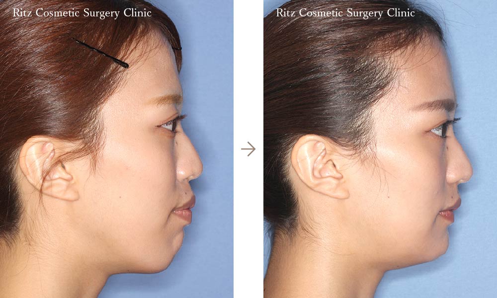 症例写真：オトガイ形成術＋両顎手術（ルフォーI型骨切り術＋下顎矢状分割術（SSRO）
