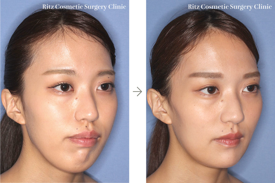 症例写真:下顎枝矢状分割術(SSRO)+ルフォーI型骨切り術(LeFort-1)+オトガイ形成術(左斜め)