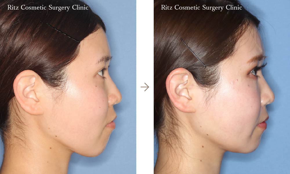 症例写真：オトガイ水平骨切り（中抜き＋前進）＋頬骨骨切り（右側面）