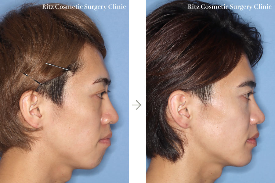 症例写真：ルフォーⅠ型骨切り術(LeFort-1)＋下顎枝矢状分割法(SSRO)（右側面）