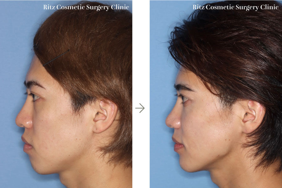症例写真：ルフォーⅠ型骨切り術(LeFort-1)＋下顎枝矢状分割法(SSRO)(左側面)