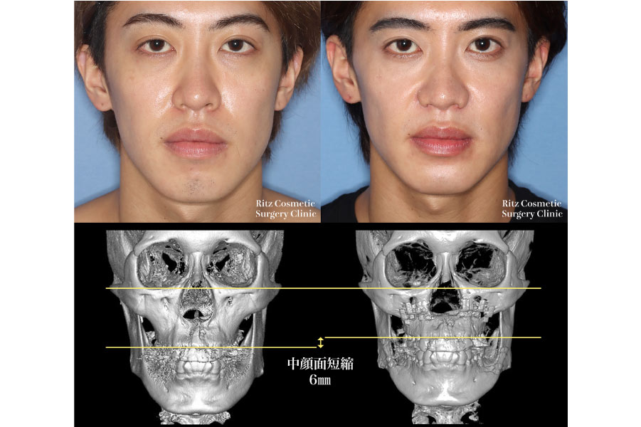 症例写真：ルフォーⅠ型骨切り術(LeFort-1)＋下顎枝矢状分割法(SSRO)