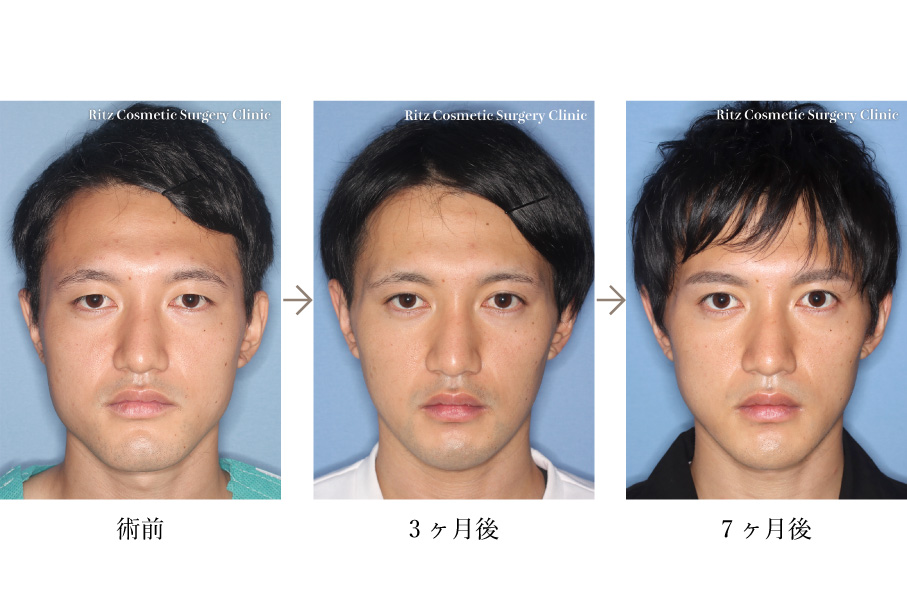 症例写真：オトガイV ライン形成術＋下顎枝矢状分割法（SSRO)＋埋没法(SMK 法）