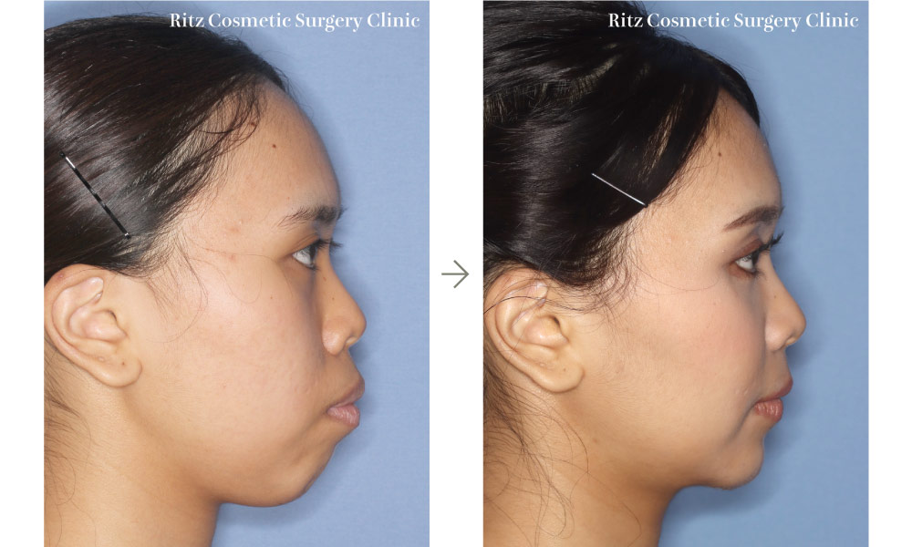 症例写真：ルフォーI型骨切り術（LeFort-1）＋下顎枝矢状分割法（SSRO）＋オトガイ水平骨切り術（ルフォー上方移動：5㎜＋後方移動：7㎜）(右側面)