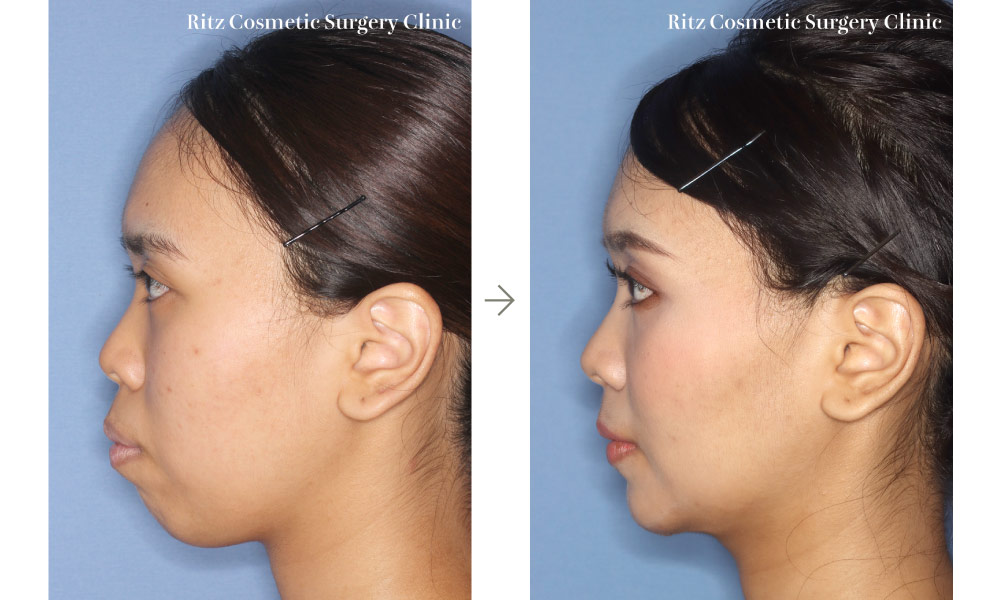 症例写真：ルフォーI型骨切り術（LeFort-1）＋下顎枝矢状分割法（SSRO）＋オトガイ水平骨切り術（ルフォー上方移動：5㎜＋後方移動：7㎜）(左側面)