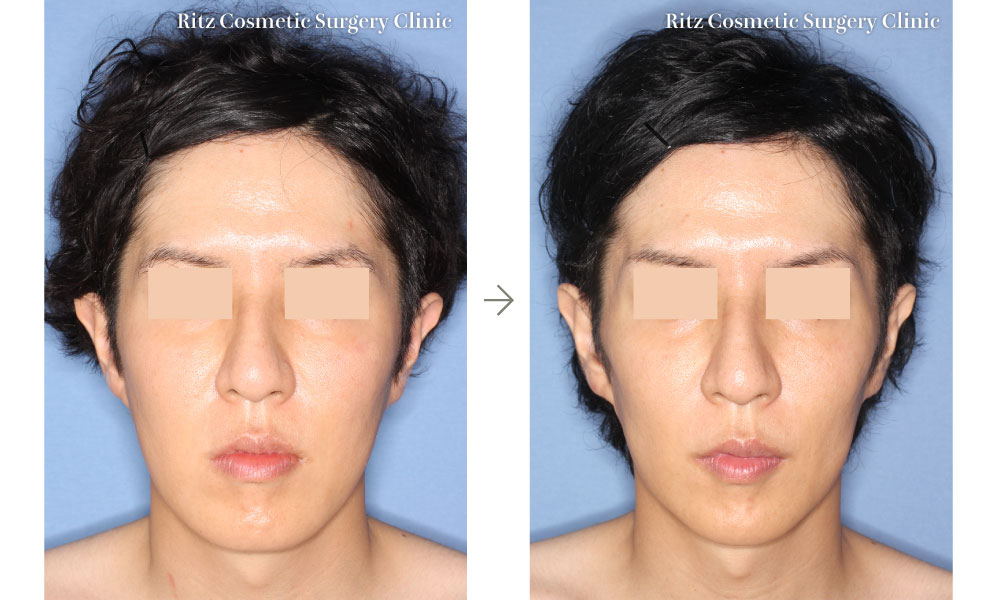 症例写真：オトガイ水平骨切り術＋下顎枝矢状分割法（SSRO）（正面）