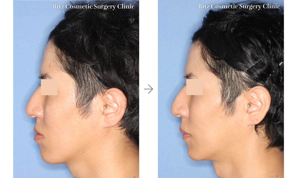 症例写真：オトガイ水平骨切り術＋下顎枝矢状分割法（SSRO）（左側面）