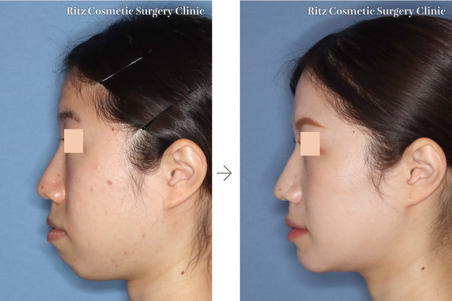 症例写真：LeFort-1型骨切り術＋下顎枝矢状分割法（SSRO）＋オトガイ水平骨切り術(左側面)