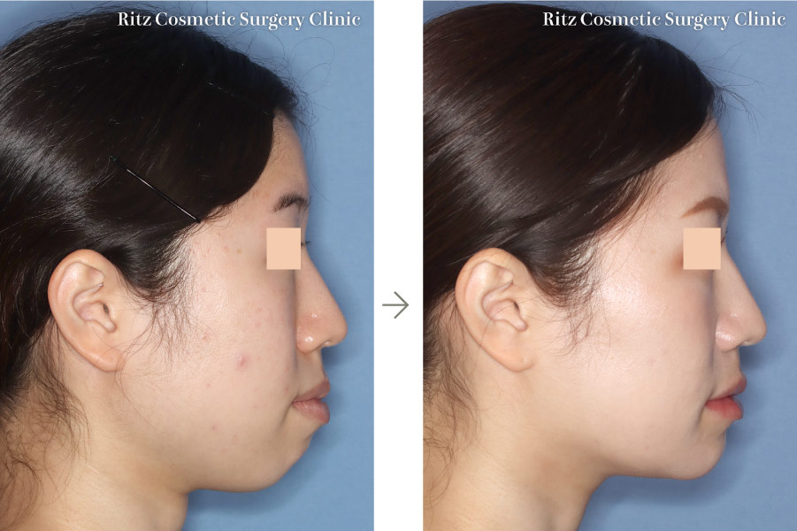 症例写真：LeFort-1型骨切り術＋下顎枝矢状分割法（SSRO）＋オトガイ水平骨切り術(右側面)