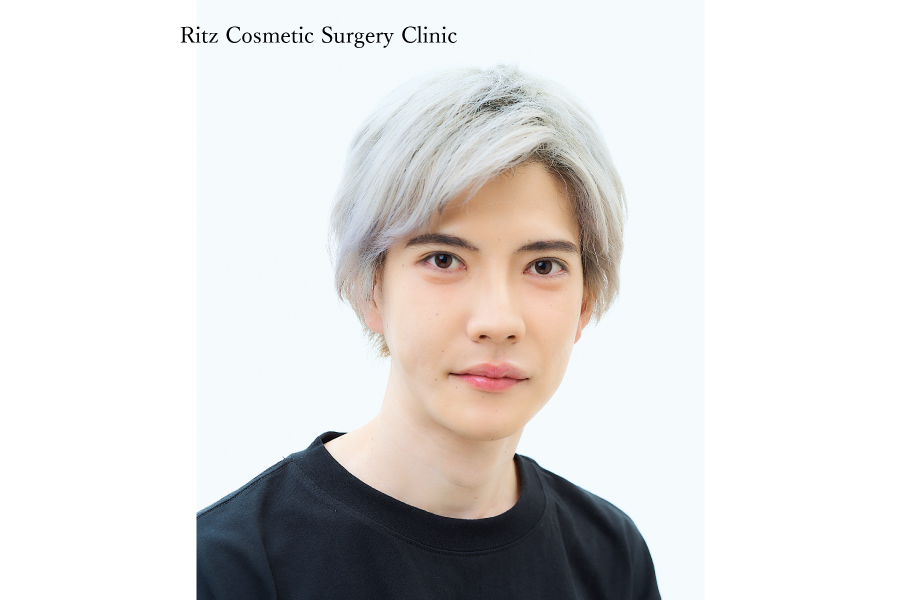 症例写真：ルフォーI型骨切り術（LeFort-1）＋下顎枝矢状分割術（SSRO）上方移動：7㎜＋後方移動：2㎜＋オトガイ水平骨切り術（中抜き：6㎜短縮+2㎜前進）＋頬骨縮小術＋下顎形成術（下顎角切除）