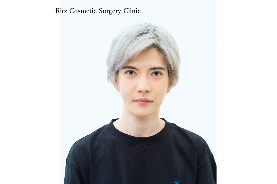 症例写真：ルフォーI型骨切り術（LeFort-1）＋下顎枝矢状分割術（SSRO）上方移動：7㎜＋後方移動：2㎜＋オトガイ水平骨切り術（中抜き：6㎜短縮+2㎜前進）＋頬骨縮小術＋下顎形成術（下顎角切除）