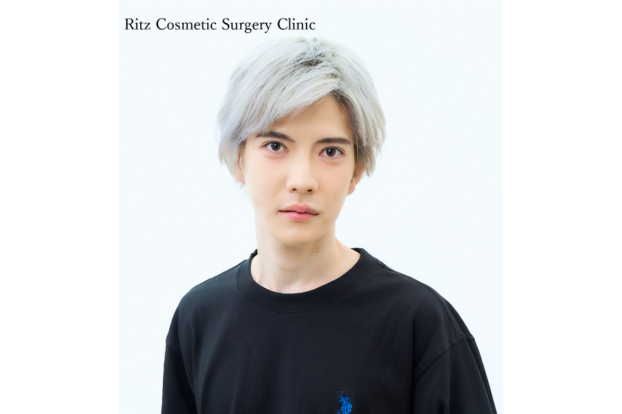 症例写真：ルフォーI型骨切り術（LeFort-1）＋下顎枝矢状分割術（SSRO）上方移動：7㎜＋後方移動：2㎜＋オトガイ水平骨切り術（中抜き：6㎜短縮+2㎜前進）＋頬骨縮小術＋下顎形成術（下顎角切除）
