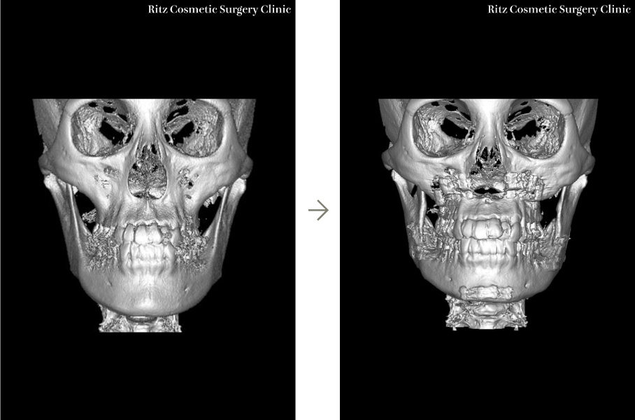症例写真：ルフォーI型骨切り術（LeFort-1）＋下顎枝矢状分割法（SSRO）＋オトガイ水平骨切り術（中抜き）（ルフォー 上方移動：中央5.5㎜＋後方移動：4㎜）(左側面)