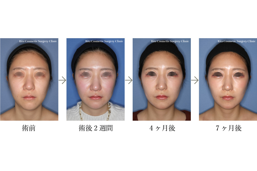 症例写真：オトガイ形成術（短縮＋前進＋左右差）