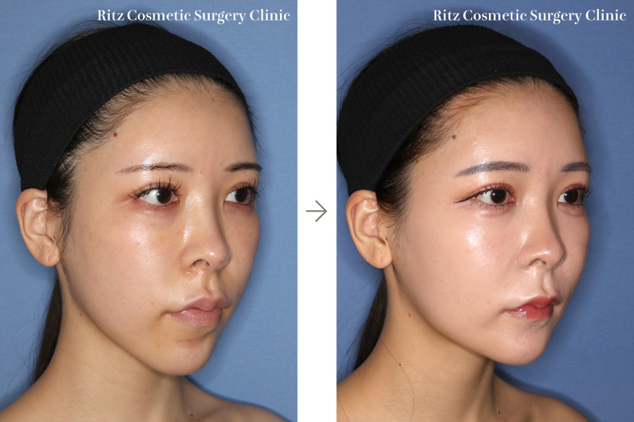 症例写真：ルフォーⅠ型骨切り術（LeFort-1）＋下顎枝矢状分割術（SSRO）（上方移動:4㎜＋後方移動:3㎜）オトガイ形成術（短縮＋前進）