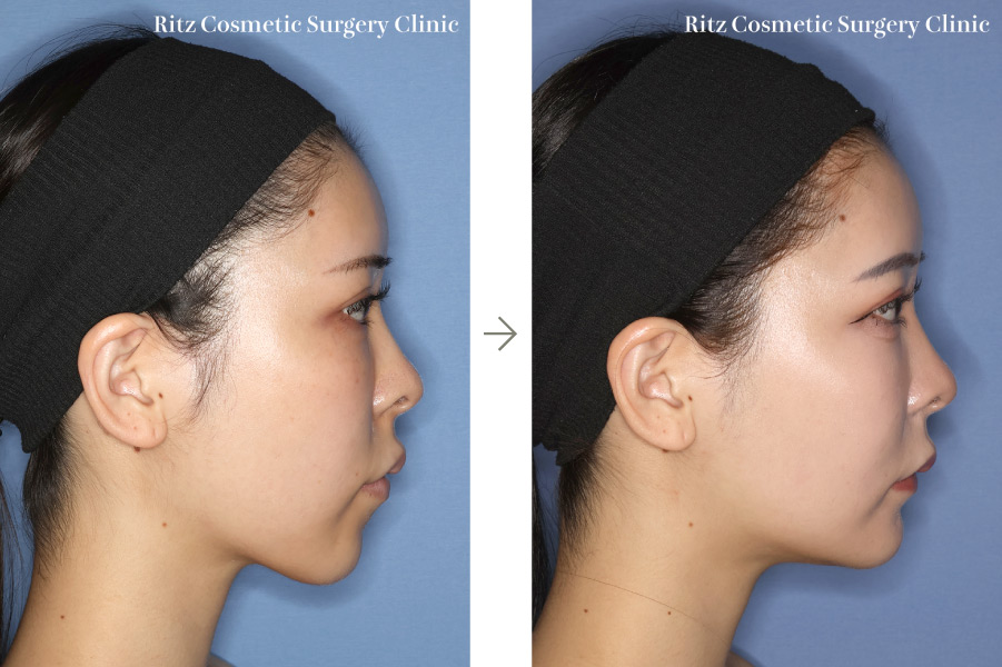 症例写真：ルフォーⅠ型骨切り術（LeFort-1）＋下顎枝矢状分割術（SSRO）（上方移動:4㎜＋後方移動:3㎜）オトガイ形成術（短縮＋前進）