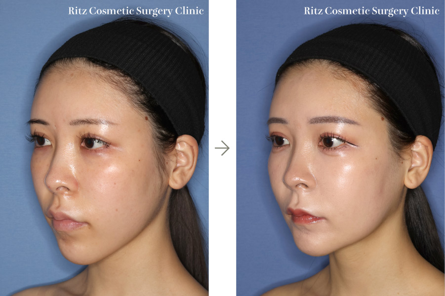 症例写真：ルフォーⅠ型骨切り術（LeFort-1）＋下顎枝矢状分割術（SSRO）（上方移動:4㎜＋後方移動:3㎜）オトガイ形成術（短縮＋前進）