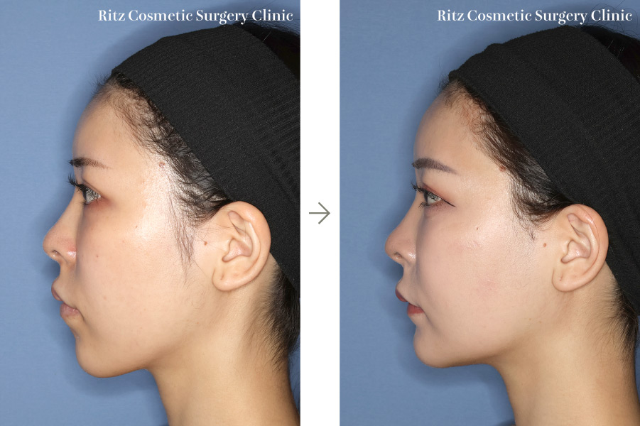 症例写真：ルフォーⅠ型骨切り術（LeFort-1）＋下顎枝矢状分割術（SSRO）（上方移動:4㎜＋後方移動:3㎜）オトガイ形成術（短縮＋前進）