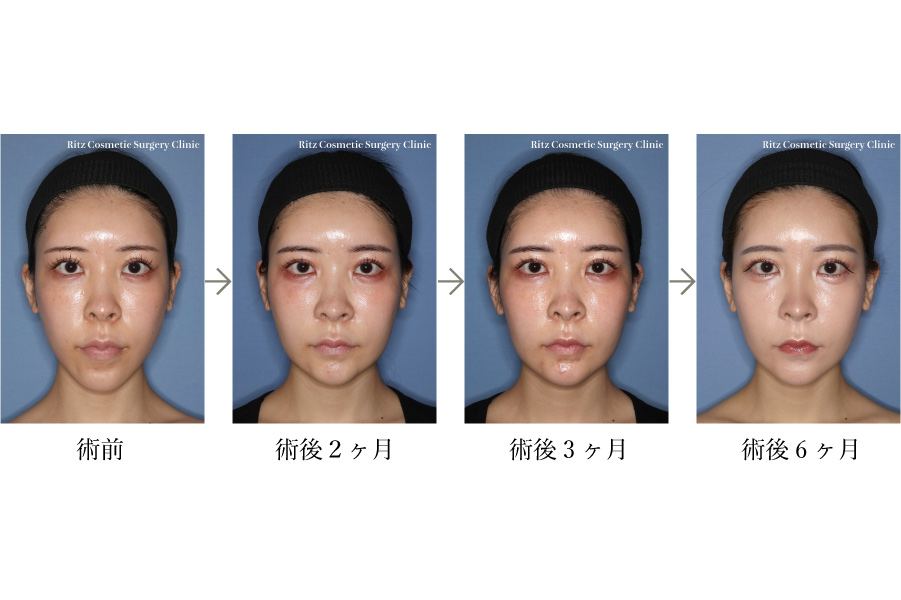 症例写真：ルフォーⅠ型骨切り術（LeFort-1）＋下顎枝矢状分割術（SSRO）（上方移動:4㎜＋後方移動:3㎜）オトガイ形成術（短縮＋前進）