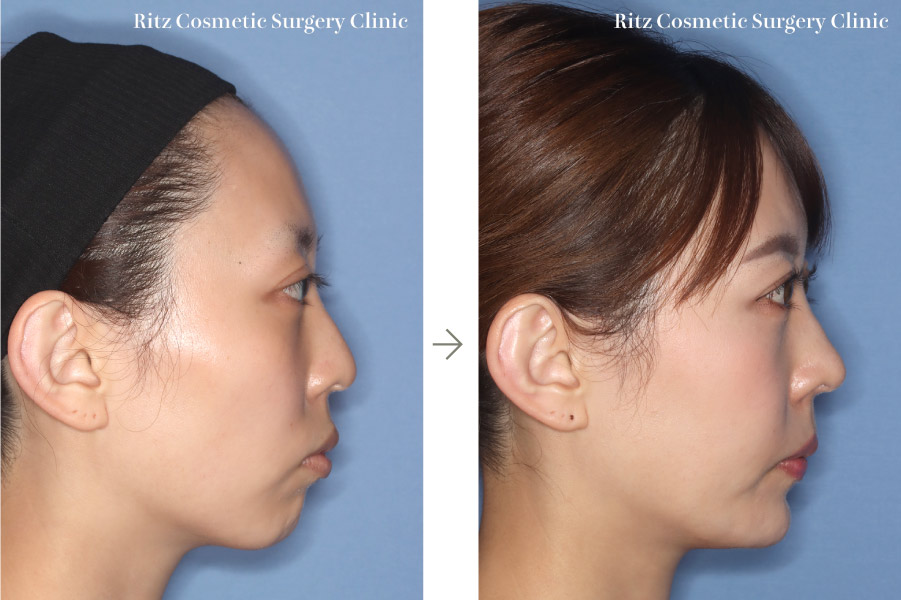 症例写真：頬骨骨切り＋顎プロテーゼ＋鼻中隔延長＋他院二重修正(右側面)