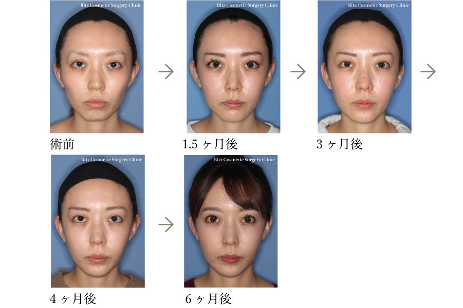 症例写真：頬骨骨切り＋顎プロテーゼ＋鼻中隔延長＋他院二重修正