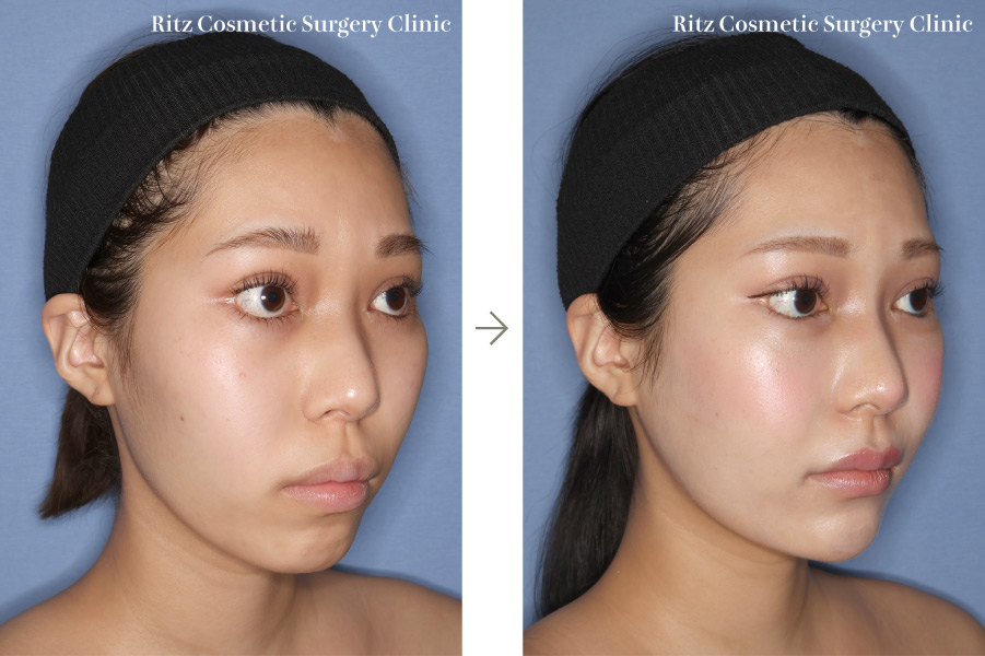 症例写真：術式：下顎枝矢状分割術（SSRO）＋ルフォーI型骨切り術（LeFort-1）＋頬骨縮小術