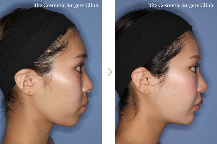 症例写真：術式：下顎枝矢状分割術（SSRO）＋ルフォーI型骨切り術（LeFort-1）＋頬骨縮小術