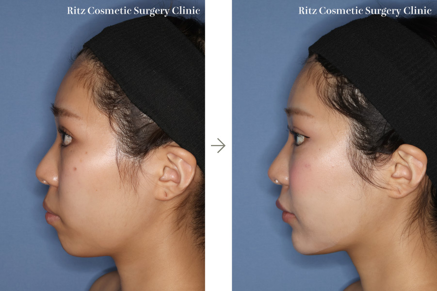 症例写真：術式：下顎枝矢状分割術（SSRO）＋ルフォーI型骨切り術（LeFort-1）＋頬骨縮小術