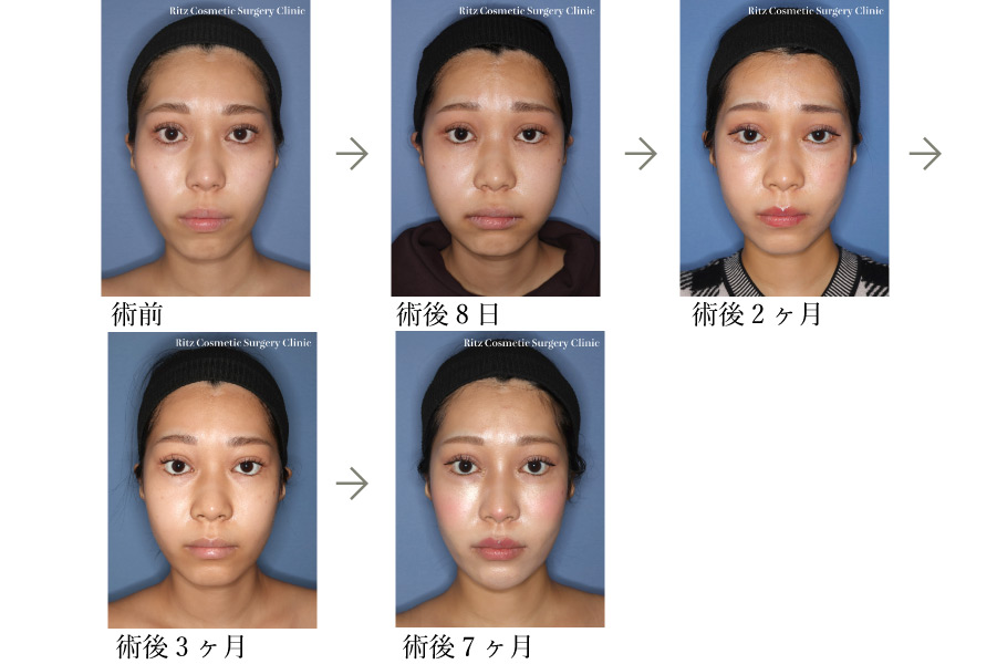 症例写真：術式：下顎枝矢状分割術（SSRO）＋ルフォーI型骨切り術（LeFort-1）＋頬骨縮小術