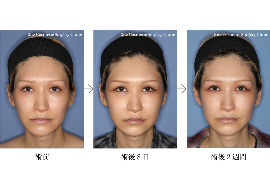 症例写真：頬骨セットバック術