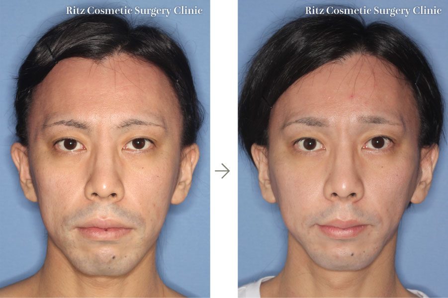 症例写真(腫れの変化)：下顎枝垂直骨切り術＋ルフォーI型骨切り術