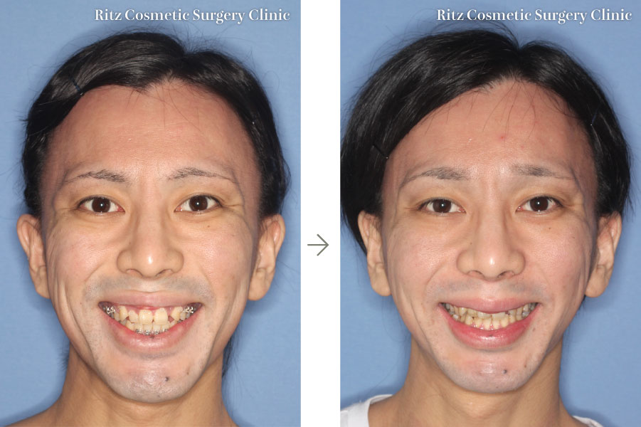 症例写真：ルフォーI型骨切り術（LeFort-1）＋下顎枝垂直骨切り法（IVRO）(正面)