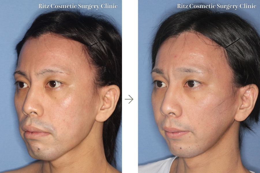 症例写真：ルフォーI型骨切り術（LeFort-1）＋下顎枝垂直骨切り法（IVRO）(左斜め)