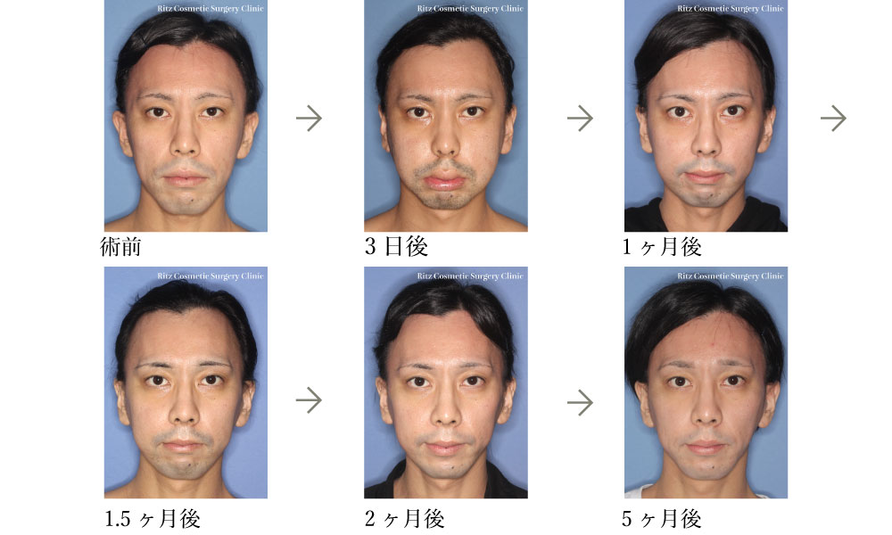症例写真(腫れの変化)：下顎枝垂直骨切り術＋ルフォーI型骨切り術（LeFort-1）
