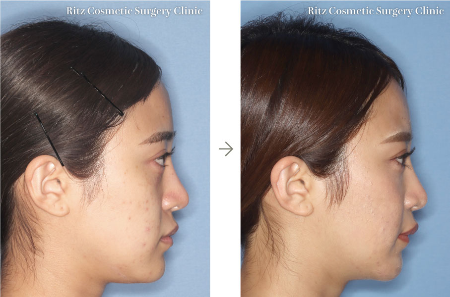 症例写真(腫れの変化)：ルフォーI型骨切り術（LeFort-1）＋下顎枝垂直骨切り法（IVRO）(右側面)