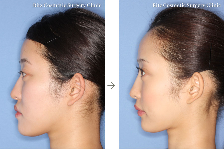 症例写真：ルフォーI型骨切り術（LeFort-1）＋下顎枝矢状分割術（SSRO）(正面の口を開けた状態)