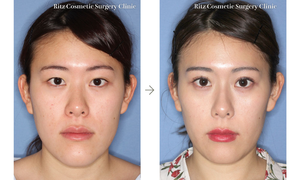 Two Jaw Surgery ：上下顎骨切り術(ASO + SSRO ) + 下顎脂肪吸引の症例写真