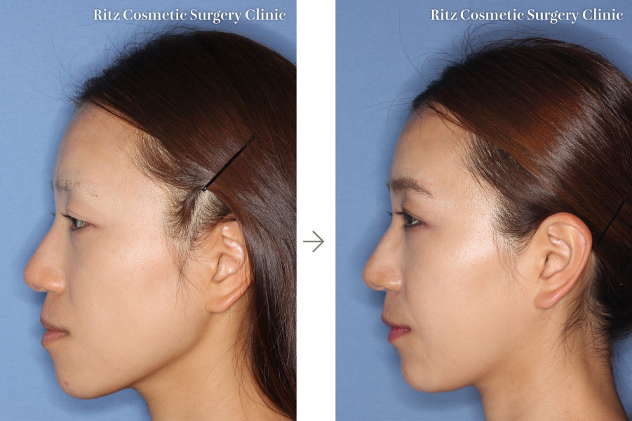 症例写真：上顎分節骨切り術＋下顎枝矢状分割法（SSRO）(左側面)